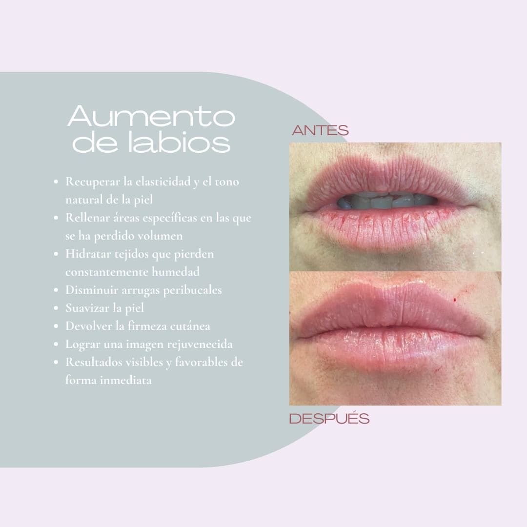 aumento labios