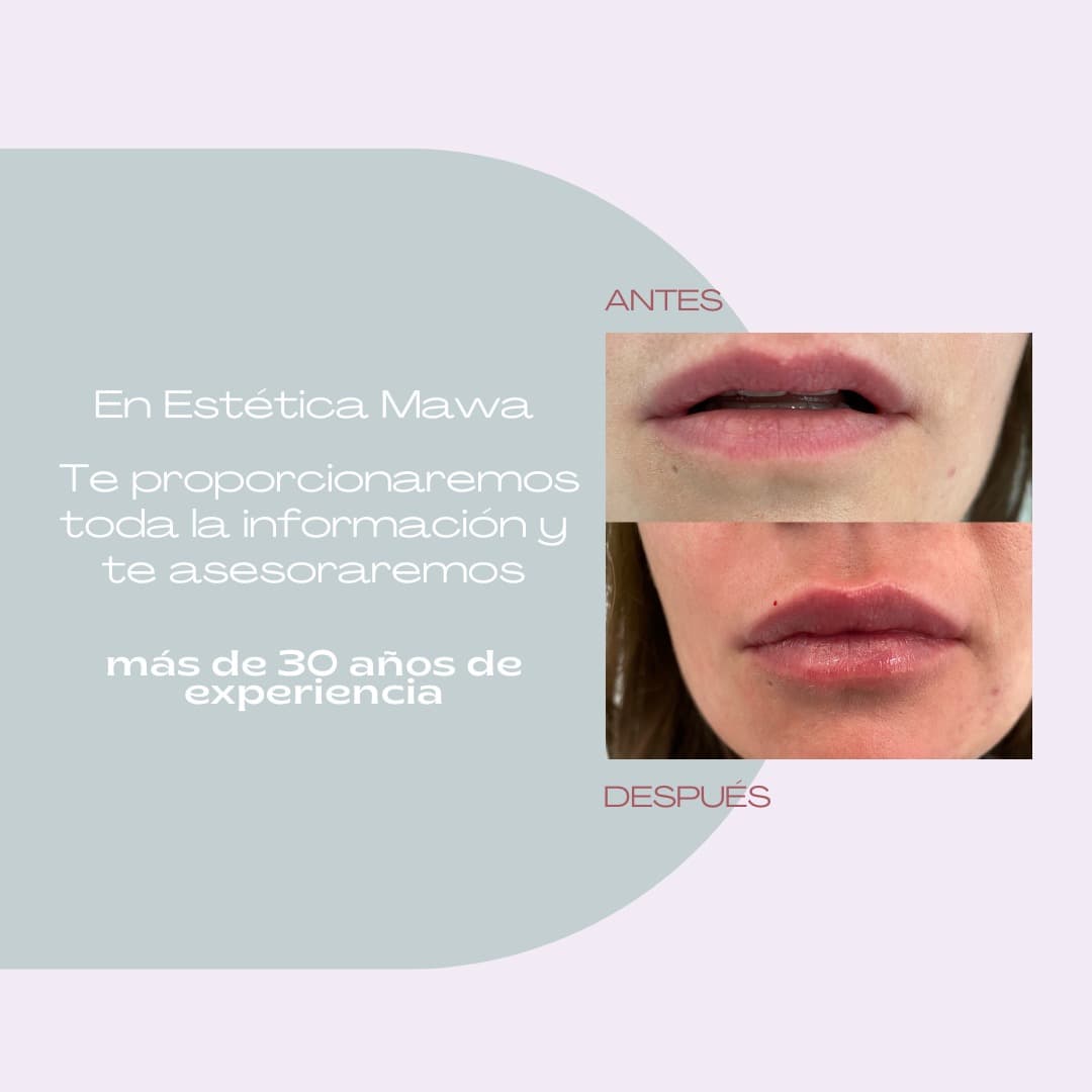 aumento labios