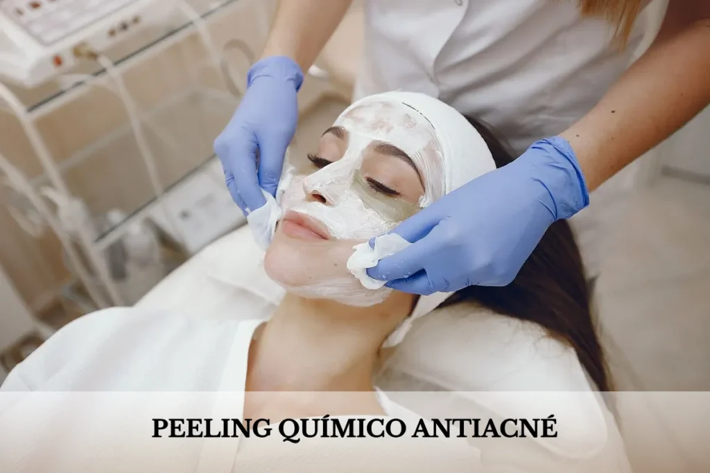 chica joven se realiza peeling quimico antiacne