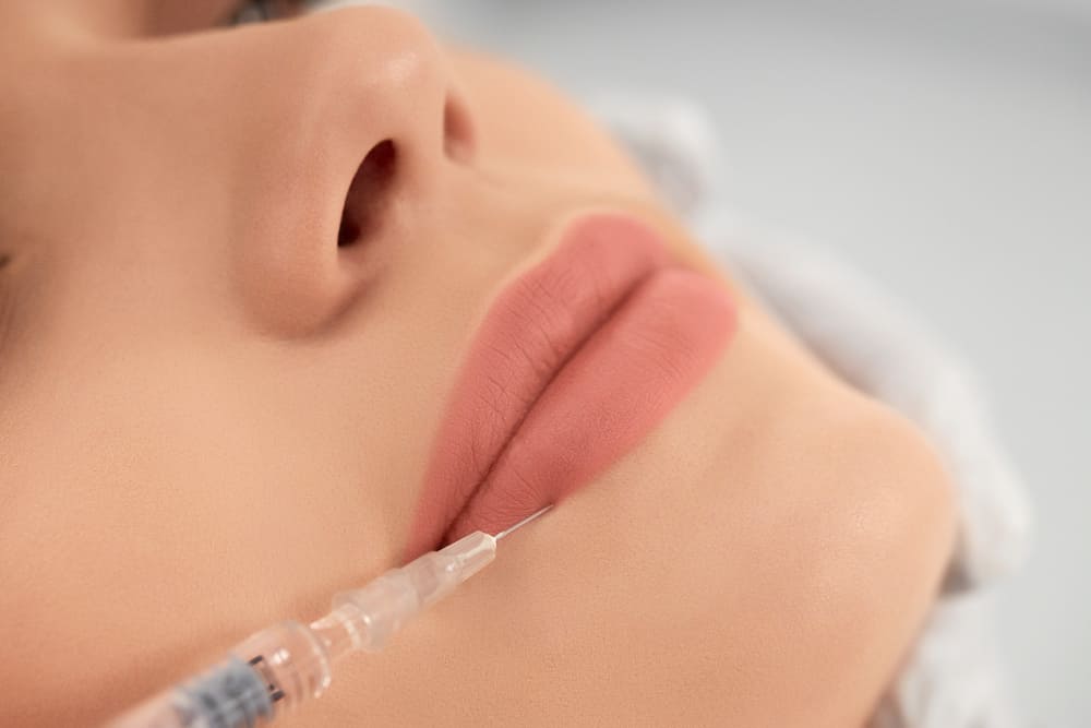 aumento labios acido hialuronico inyeccion estetica