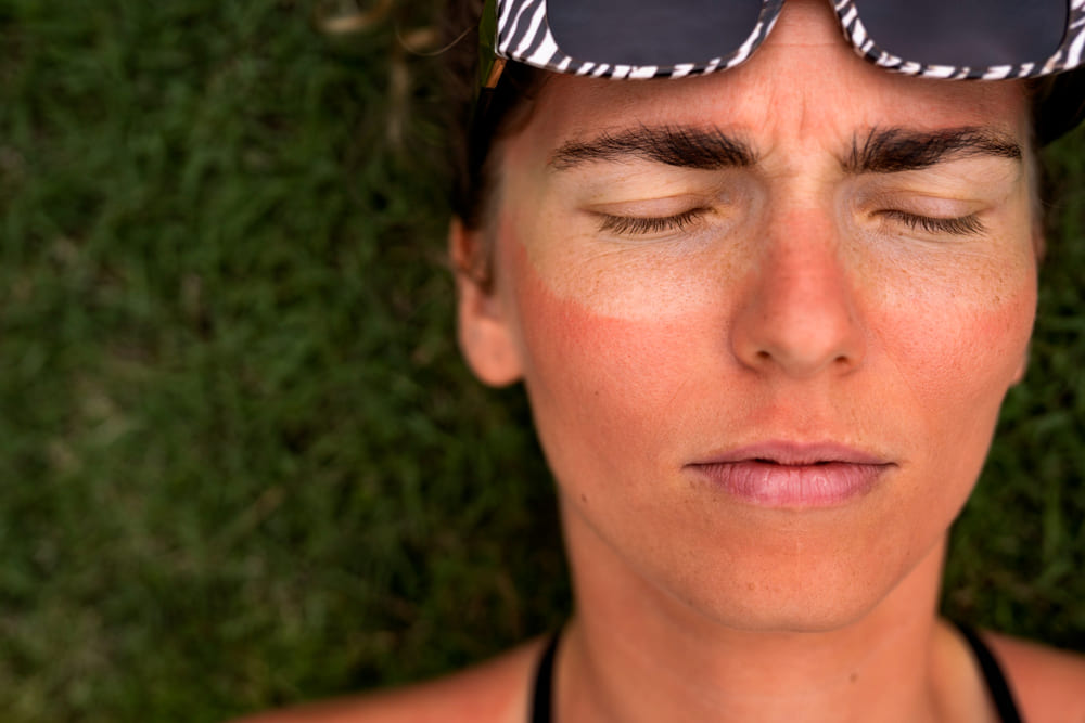 mujer con quemadura solar en rostro tratamiento facial clinica estetica mawa majadahonda
