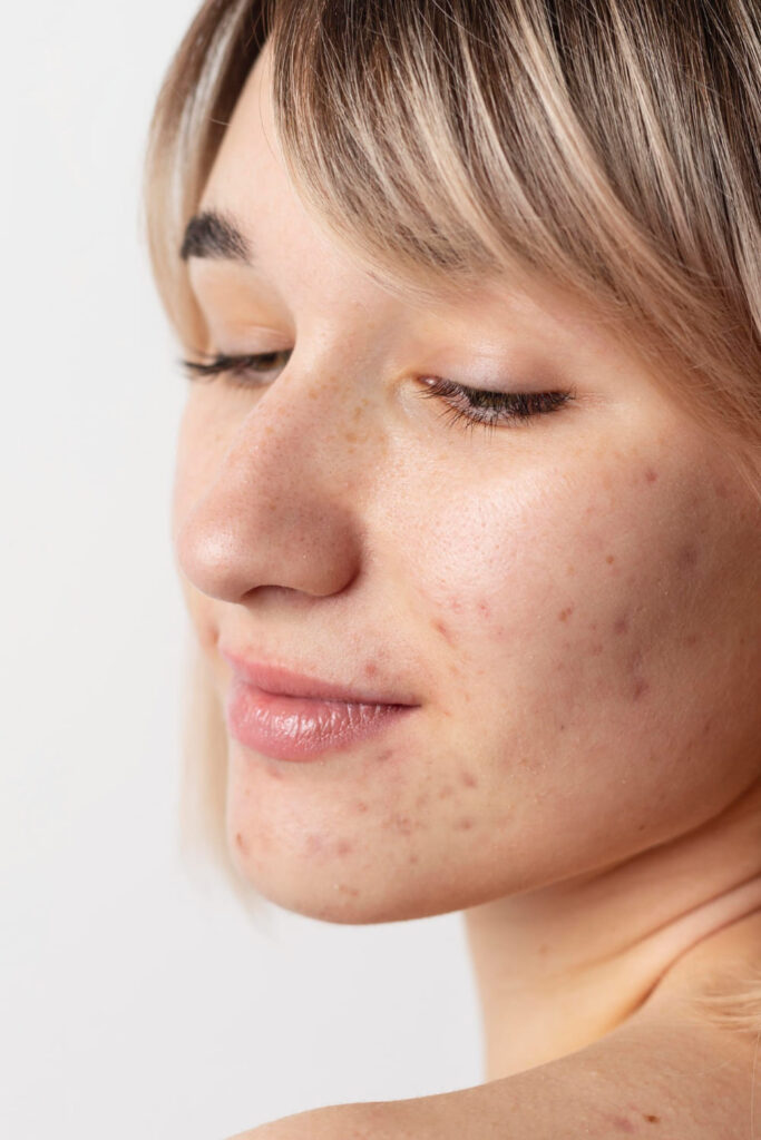 piel con acne tratamiento dermatologico clinica estetica mawa majadahonda