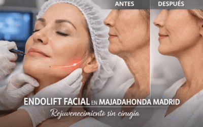 Endolift en Majadahonda: el rejuvenecimiento facial sin cirugía que está revolucionando Madrid Oeste