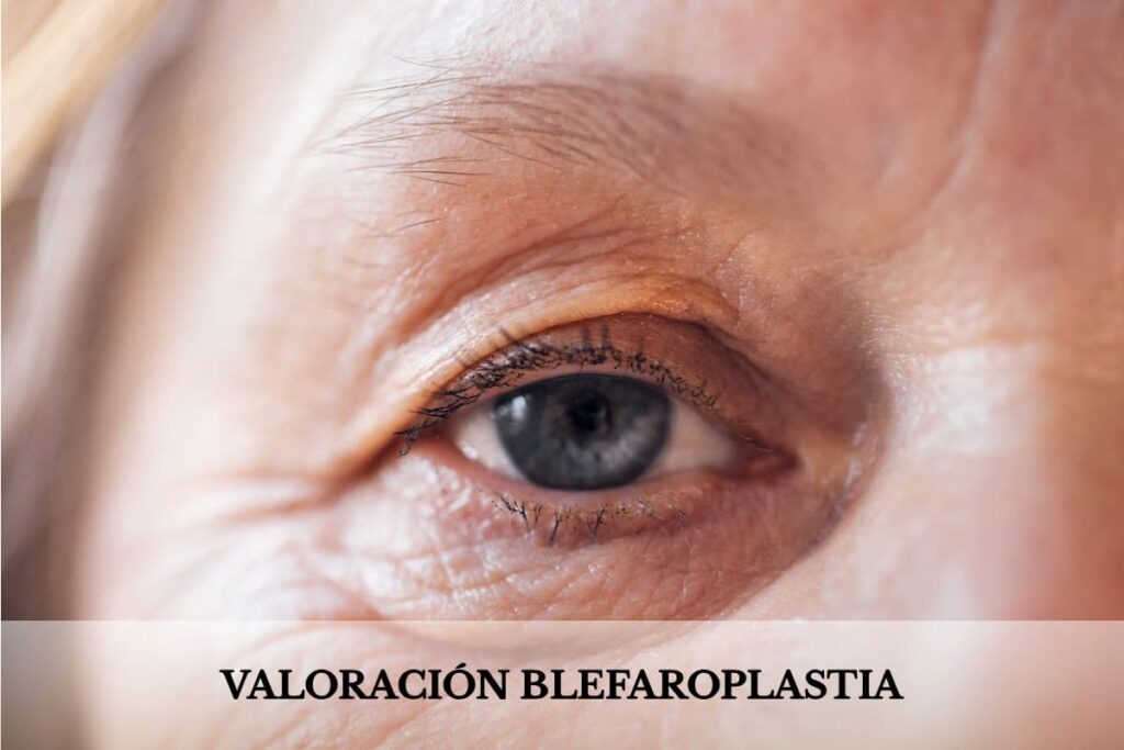 exploracion parpados superiores inferiores valoracion blefaroplastia clinica mawa exploracion parpados superiores inferiores valoracion blefaroplastia clinica mawa