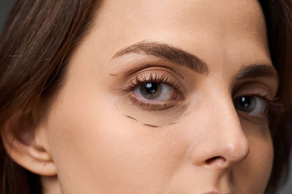 mirada rejuvenecida blefaroplastia resultados naturales clinica estetica mawa majadahonda