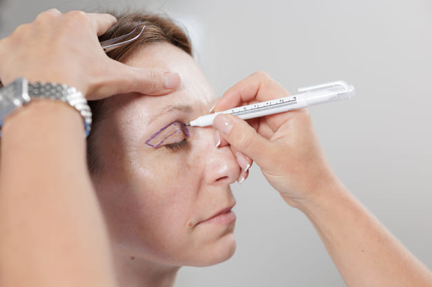 valoracion blefaroplastia majadahonda consulta medica parpados clinica mawa valoracion blefaroplastia majadahonda consulta medica parpados clinica mawa